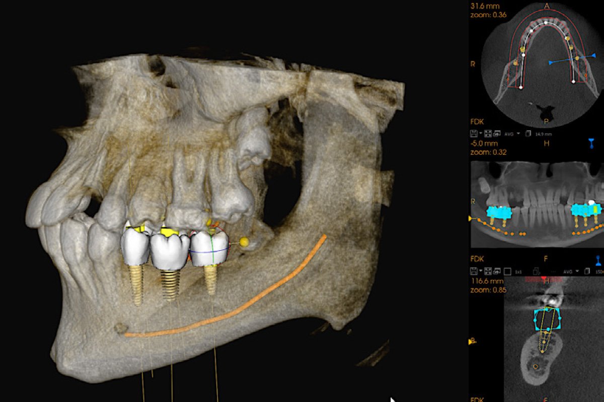Three-dimensional dental implant planning image used to prepare for full-arch treatment